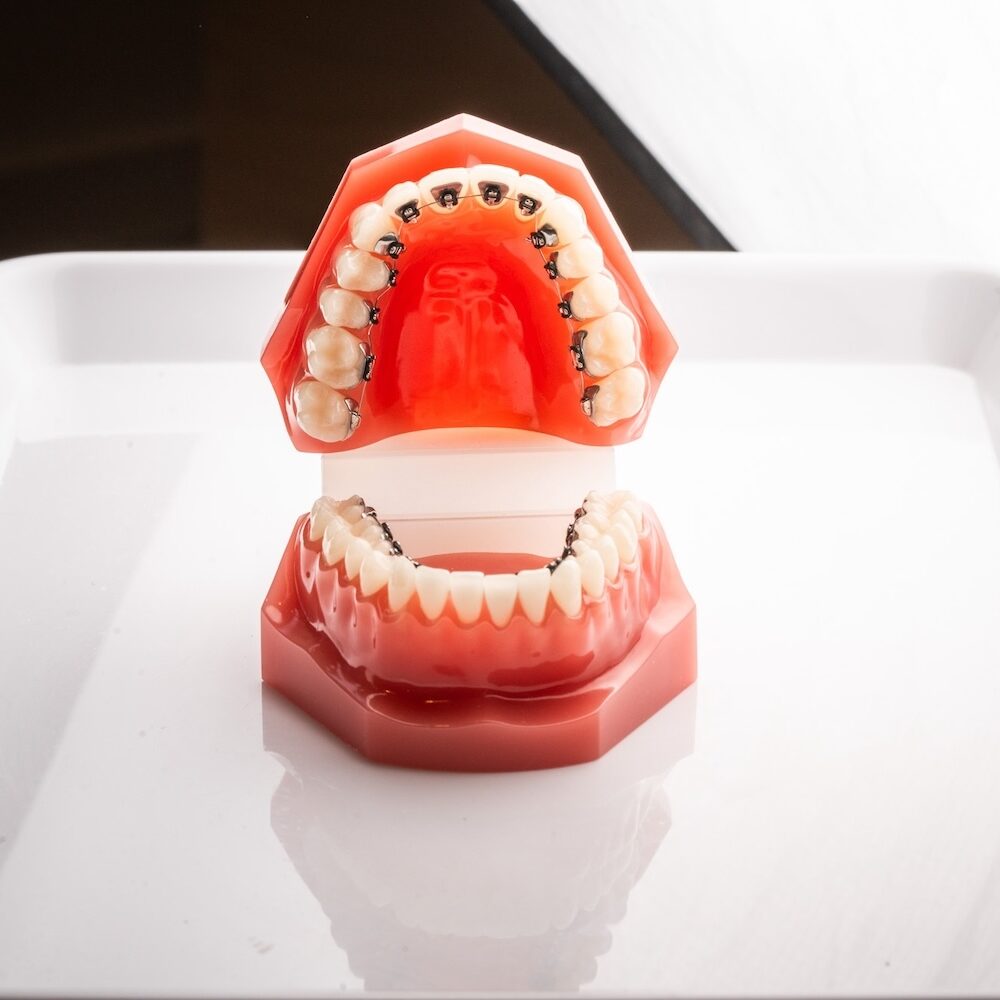 Appareil dentaire lingual